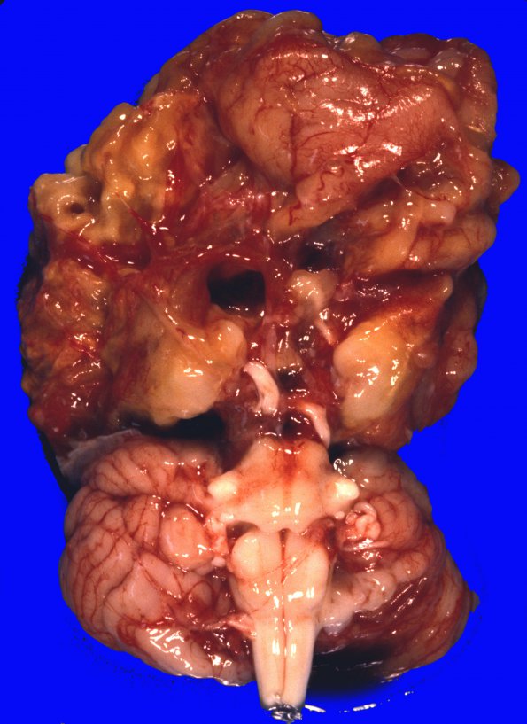 1A2 Multicystic encephalopathy (Case 1) 2