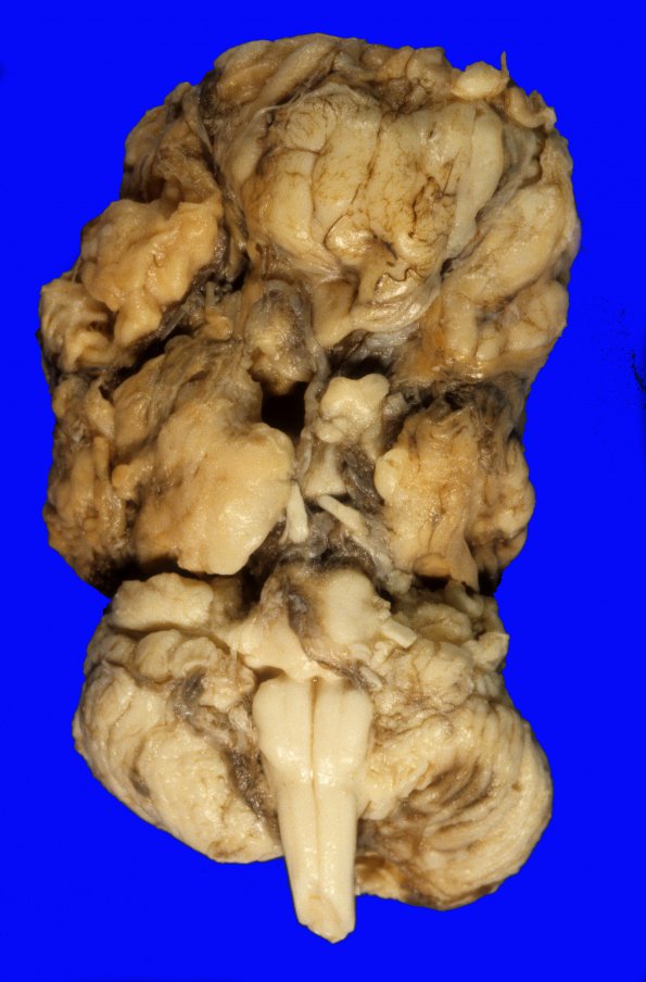 1A3 Multicystic encephalopathy (Case 1) 9 (2)