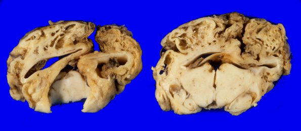 1A5 Multicystic encephalopathy (Case 1) 5