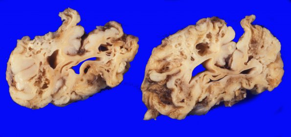 1A6 Multicystic Encephalopathy (Case 1) A2