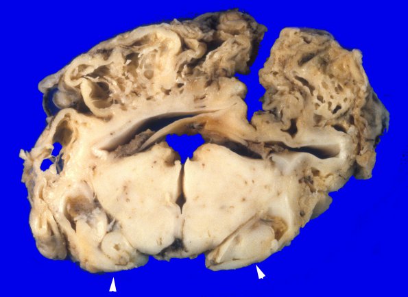 1A7 Multicystic Encephalopathy (Case 1) A5 copy