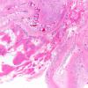 1B2 Multicystic encephalopathy (Case 1) H&E 2