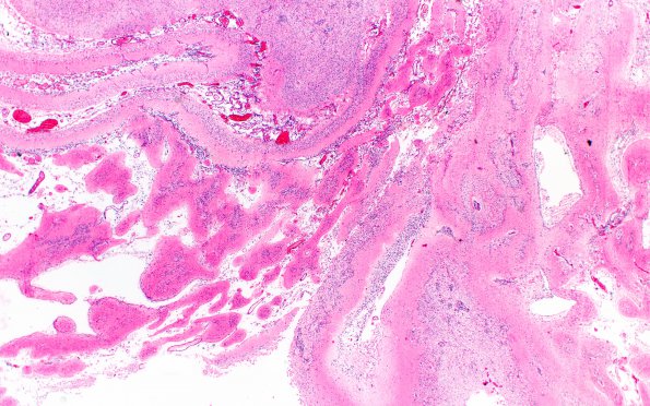 1B2 Multicystic encephalopathy (Case 1) H&E 2