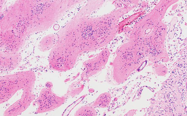 1B3 Multicystic encephalopathy (Case 1) H&E 1