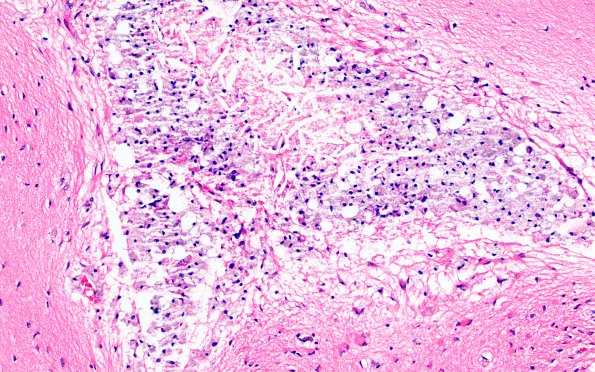 1B4 Multicystic encephalopathy (Case 1) H&E 5