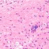 1B5 Multicystic encephalopathy (Case 1) H&E 3