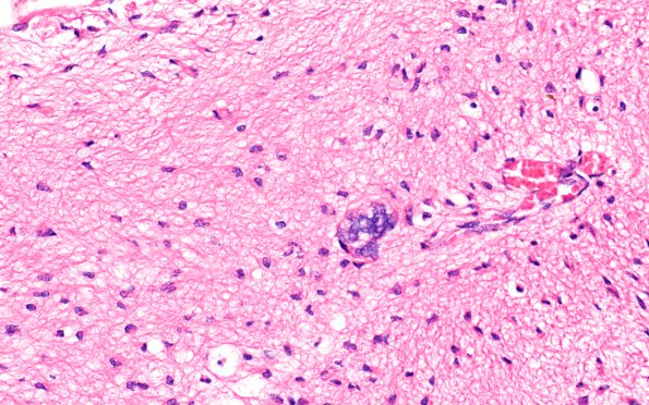 1B5 Multicystic encephalopathy (Case 1) H&E 3