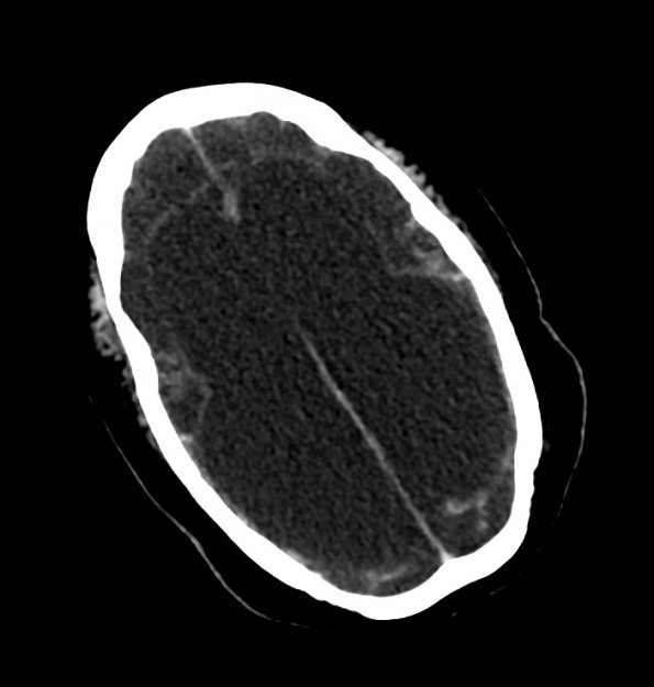 2A1 MCE (Case 2) CT 2 - Copy