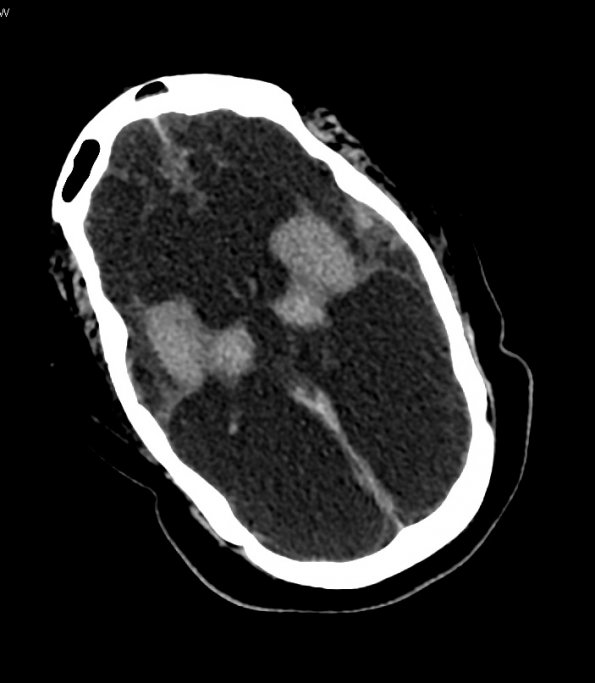 2A2 MCE (Case 2) CT 1 - Copy