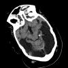 2A3 MCE (Case 2) CT 3 - Copy