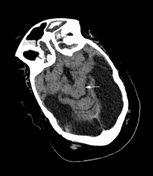 2A3 MCE (Case 2) CT 3 - Copy