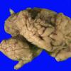 2B2 Multicystic Encephalopathy (MCE, Case 2) _8