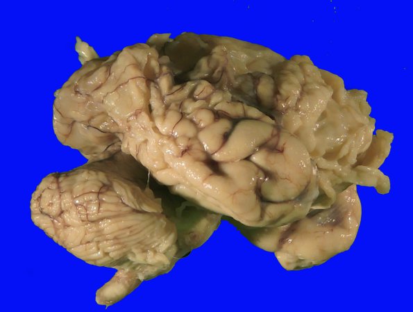 2B2 Multicystic Encephalopathy (MCE, Case 2) _8