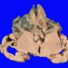 2B3 Multicystic Encephalopathy (MCE, Case 2) _9