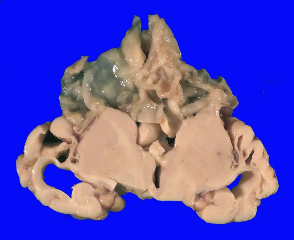 2B3 Multicystic Encephalopathy (MCE, Case 2) _9