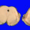 2B5 Multicystic Encephalopathy (MCE, Case 2) _12