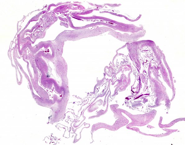 2C3 MCE (Case 2) N11 H&E WM