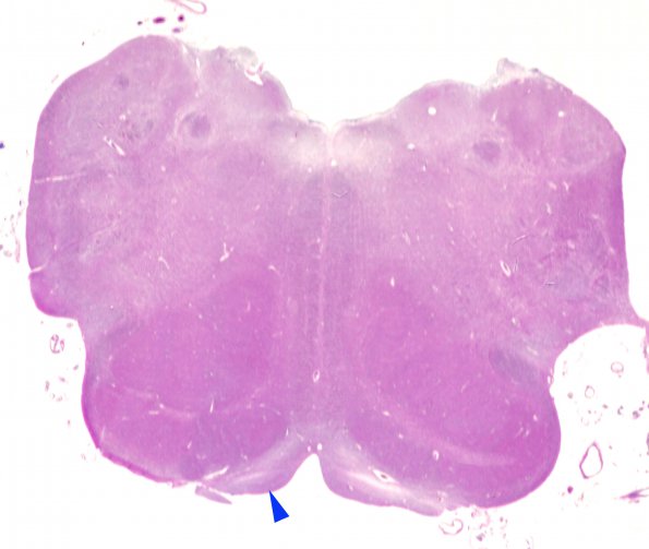 2C7 MCE (Case 2) N19 H&E WM copy A