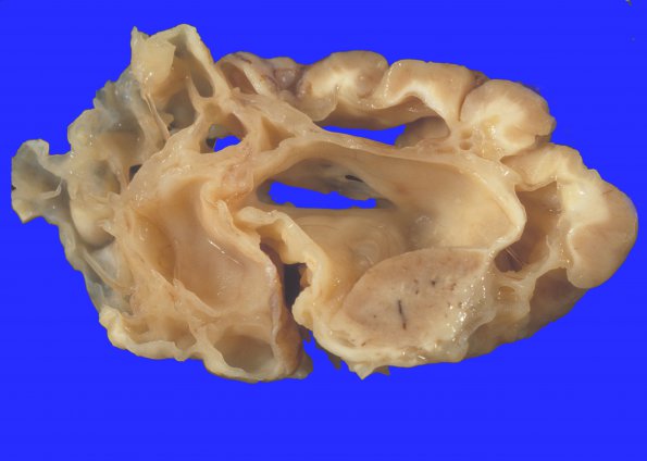 3A1 Hypoxia-Ischemia, neonatal, MCE (Case 3) 3