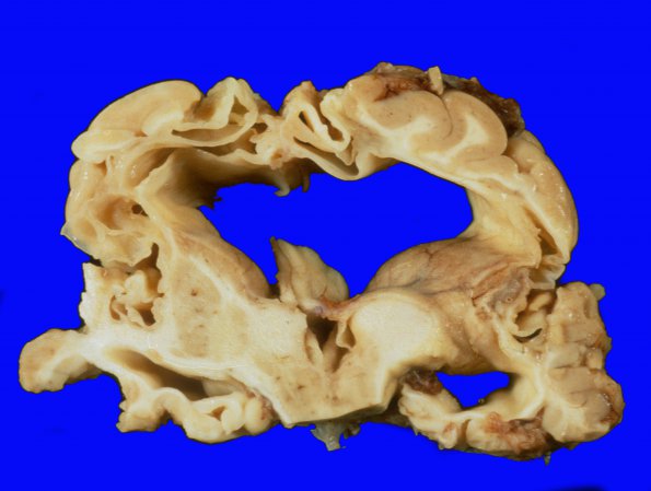 3A2 Multicystic encephalopathy (Case 3) 8