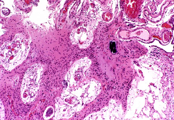 3B2 Multicystic encephalopathy (Case 3) 4