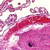 3B3 Multicystic encephalopathy (Case 3) H&E whole mount