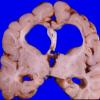 4A3 Neonatal Hypoxic patterns & MCE (Case 4)