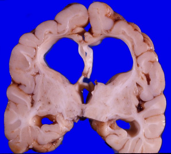 4A3 Neonatal Hypoxic patterns & MCE (Case 4)