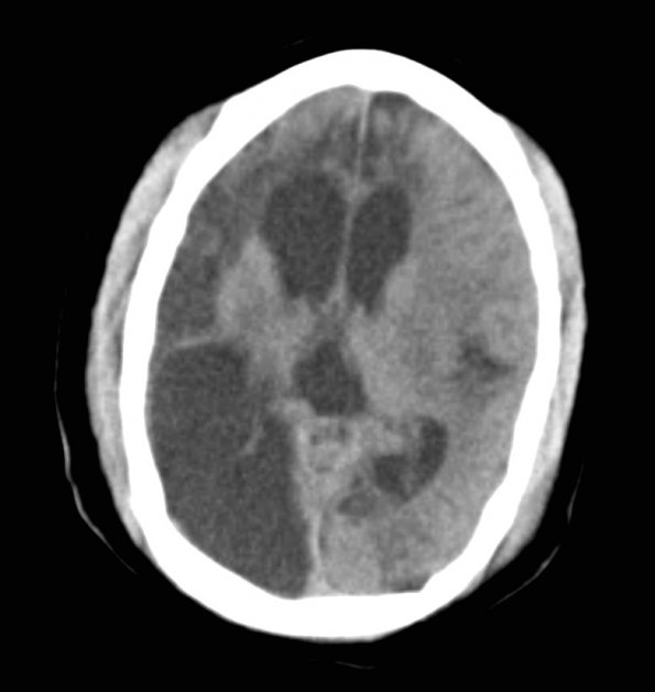 5A2 MCE (Case 5) CT 2 - Copy