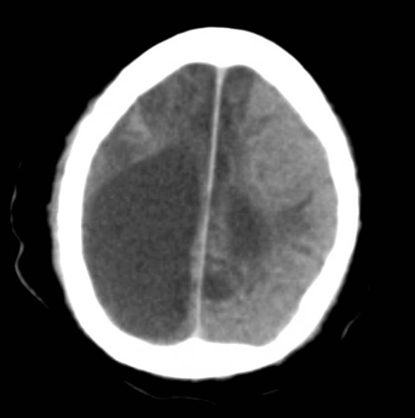 5A3 MCE (Case 5) CT 3 - Copy