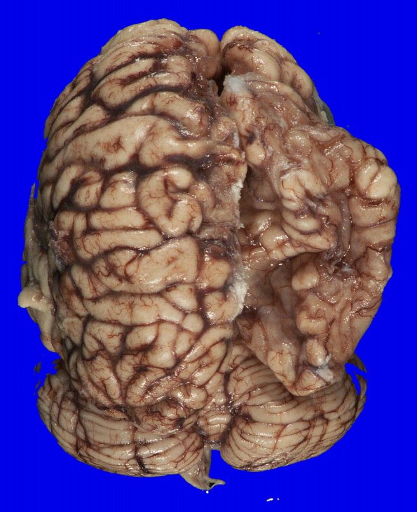 5B1 Hypoxia-Ischemia, neonatal (Case 5) 1