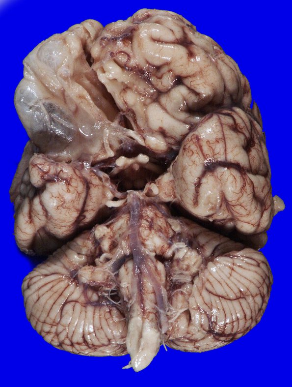 5B3 Porencephaly-Status Marmoratus-Ulegyria (Case 5) Gross_1