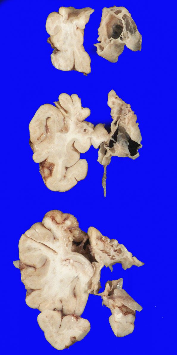 5B4 Hypoxia-Ischemia, neonatal, survival to adult, 500gm (Case 5) 6 (2)