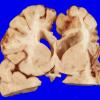 5B5 Hypoxia-Ischemia, neonatal, MCE (Case 5) 7 (2)