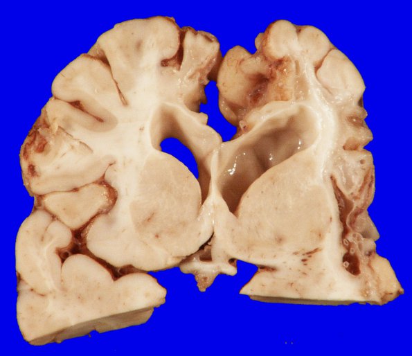 5B5 Hypoxia-Ischemia, neonatal, MCE (Case 5) 7 (2)