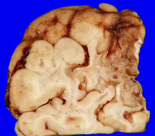 5B6 Hypoxia-Ischemia, neonatal, survival to adult, 500gm (Case 5) 17