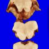 5B7 Hypoxia-Ischemia, neonatal, survival to adult, 500gm (Case 5) 26