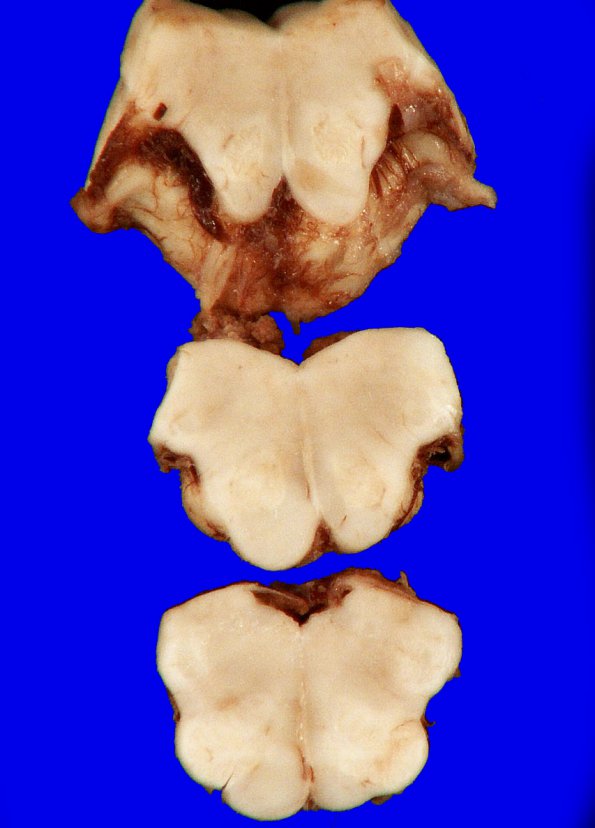 5B7 Hypoxia-Ischemia, neonatal, survival to adult, 500gm (Case 5) 26