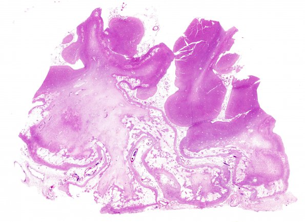 5C1 Hypoxia-Ischemia, neonatal, MCE (Case 5) N13 H&E WM