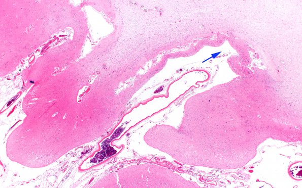 5C2 Hypoxia-Ischemia, neonatal, MCE (Case 5) N13 H&E 2X 2 copy