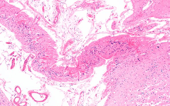 5C3 Hypoxia-Ischemia, neonatal, MCE (Case 5) N13 H&E 3