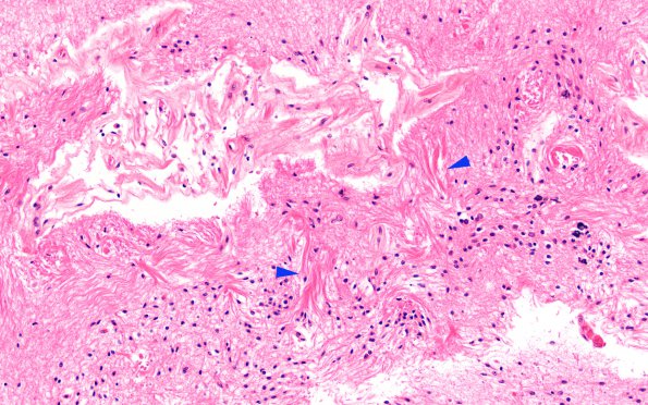 5C4 Hypoxia-Ischemia, neonatal, MCE (Case 5) N13 H&E 20X copy