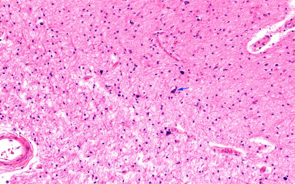 5C5 Hypoxia-Ischemia, neonatal, MCE (Case 5) N13 H&E 2 copy