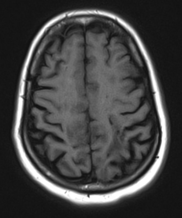 1A3 Laminar necrosis (Case 1) T1 no contrast 2 - Copy