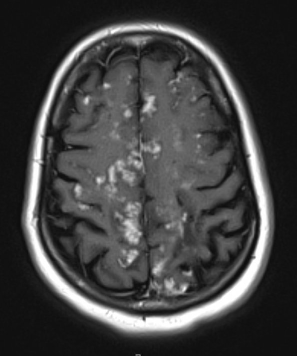 1A4 Laminar necrosis (Case 1) T1 W & contrast - Copy