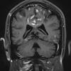 1A5 Infarcts, acute-chronic, laminar necrosis (Case 1)  T1 W 6 - Copy