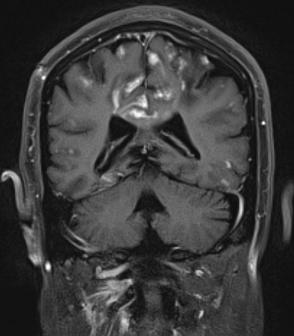 1A5 Infarcts, acute-chronic, laminar necrosis (Case 1)  T1 W 6 - Copy