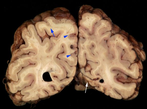 1B Laminar necrosis (Case 1) Gross 10 copy