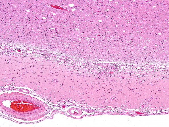 1C2 Laminar necrosis (Case 1) N19 H&E 9