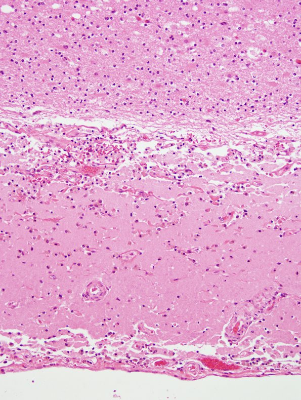 1C3 Laminar necrosis (Case 1) N19 H&E 5